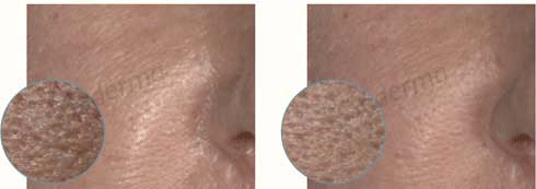 shrink pores that are large